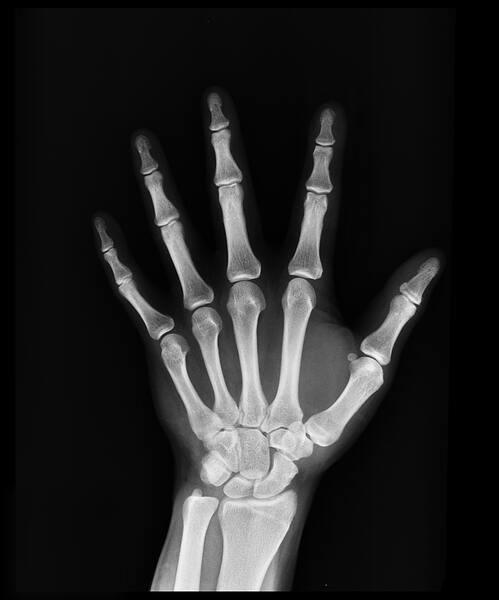 Can Children Acquire Their Parents’ History of Fracture?