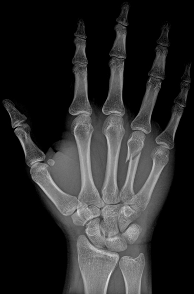 3D Printed Polymer Scaffolds for Bone Tissue Regeneration