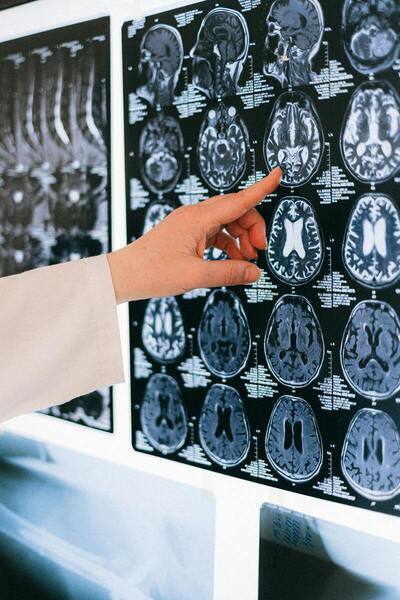C reactive protein and risk of neurological deficits and disability in patients with acute ischemic stroke